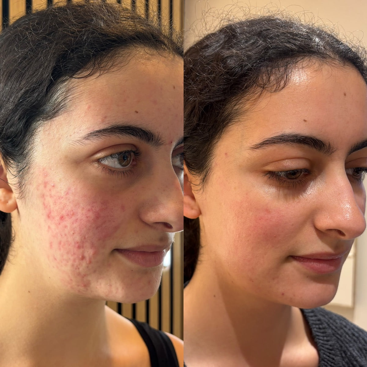 Acne scarring — before and after at The Face Tonic