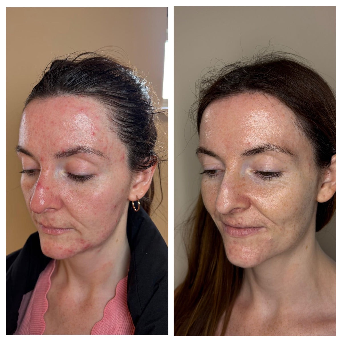 Active acne — before and after at The Face Tonic