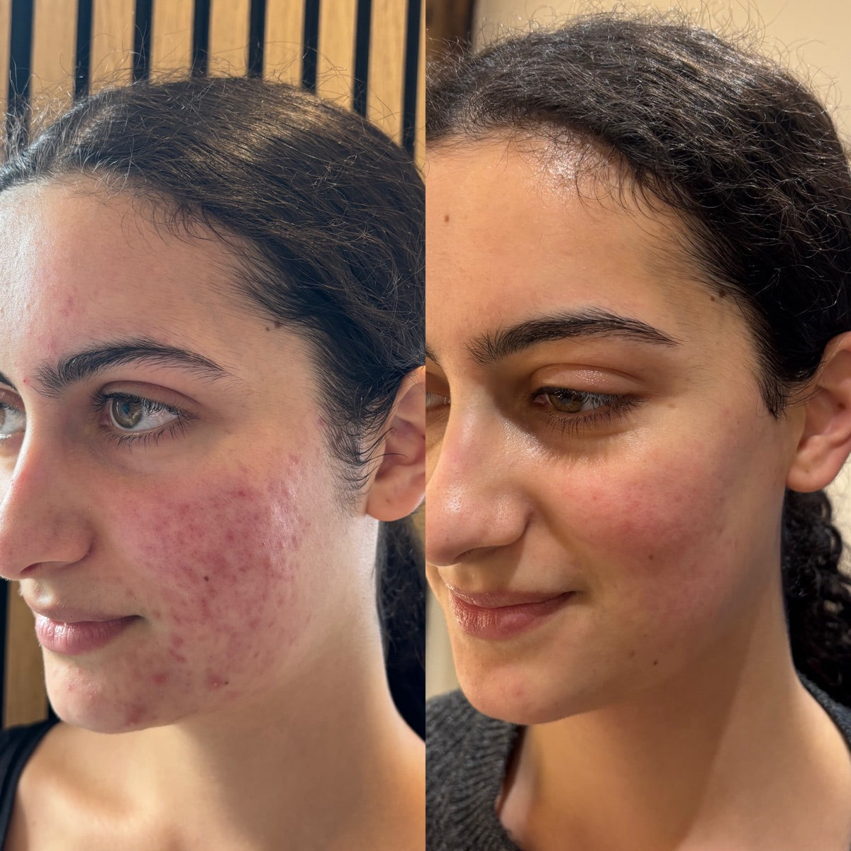 Acne scarring — before and after at The Face Tonic