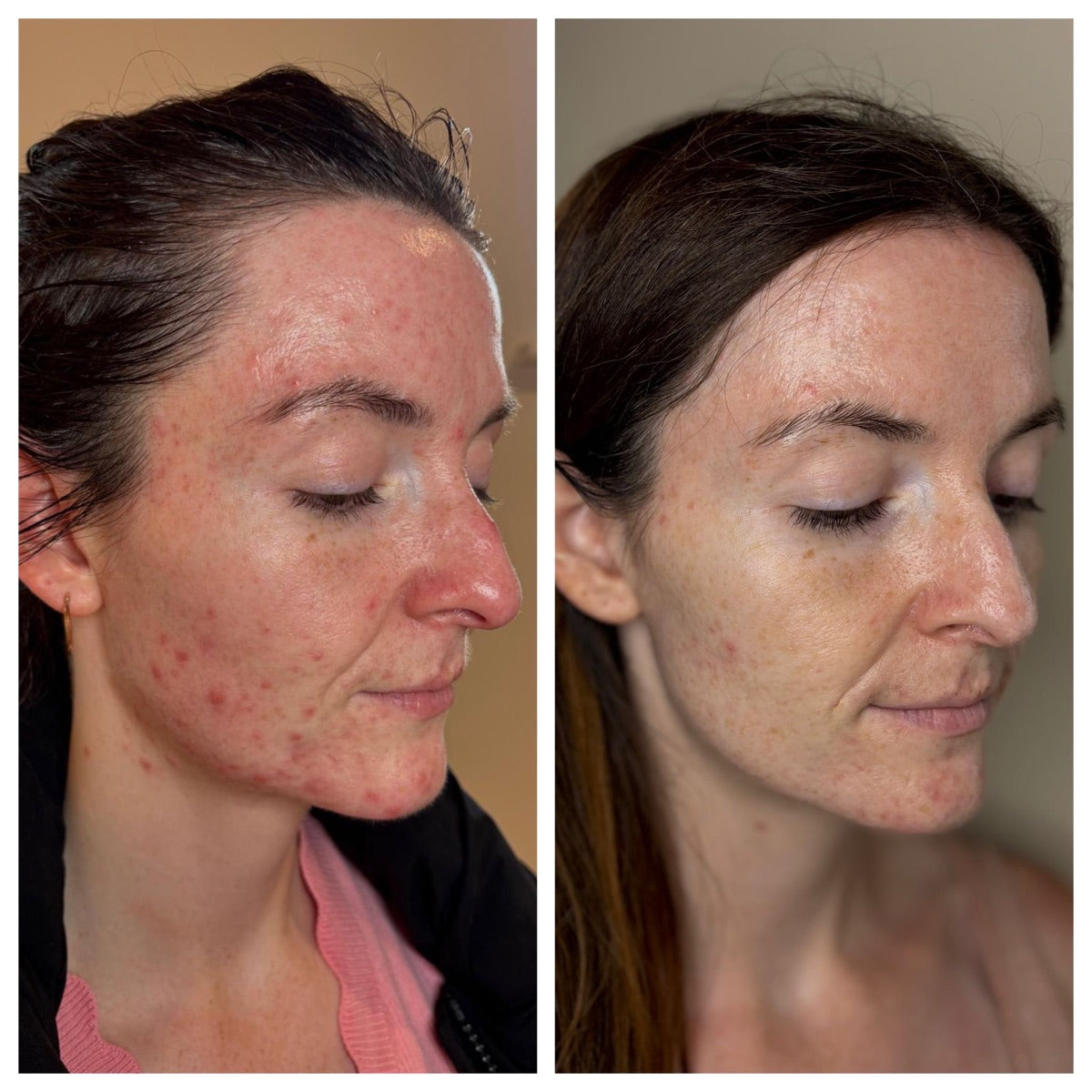 Active acne — before and after at The Face Tonic