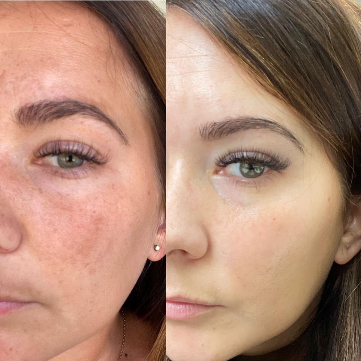 Pigmentation — before and after at The Face Tonic